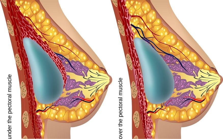 Chirurgie esthétique des seins : Reconstruction mammaire à Niort (79)