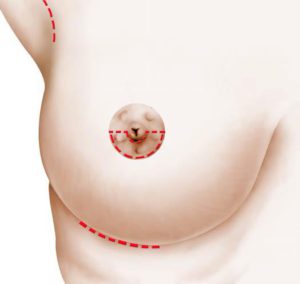 Augmentation des seins par prothèse - Chirurgie esthétique Niort 79