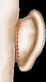 Dr Behbahani - Chirurgie des oreilles ou otoplatie à Niort