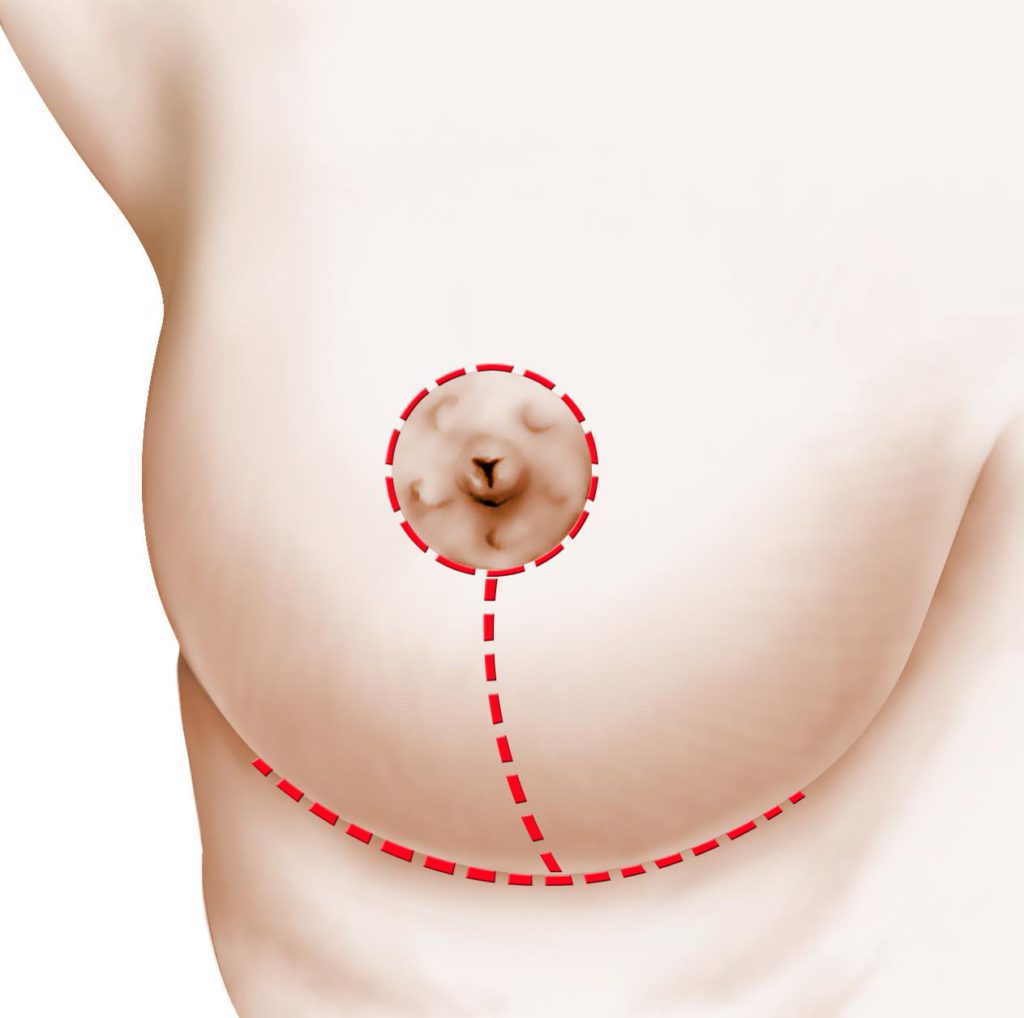 chirurgie des seins hypertrophie mammaire